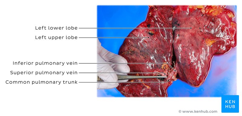 Lung with an aberrant common left pulmonary venous trunk