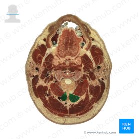 Músculo reto posterior maior da cabeça (Musculus rectus capitis posterior major); Imagem: National Library of Medicine