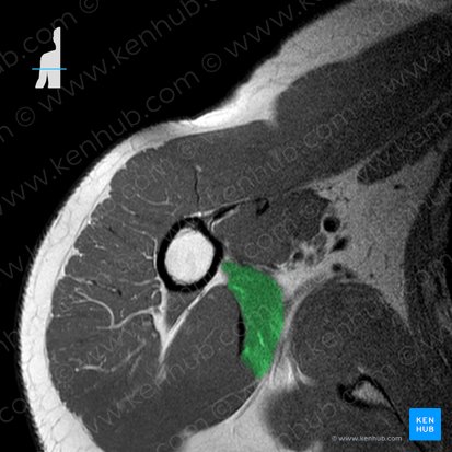 Músculo redondo mayor (Musculus teres major); Imagen: 