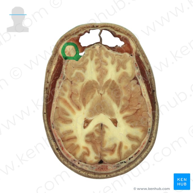 Superfície superior da placa orbital do osso frontal (Facies superior laminae orbitalis ossis frontalis); Imagem: National Library of Medicine