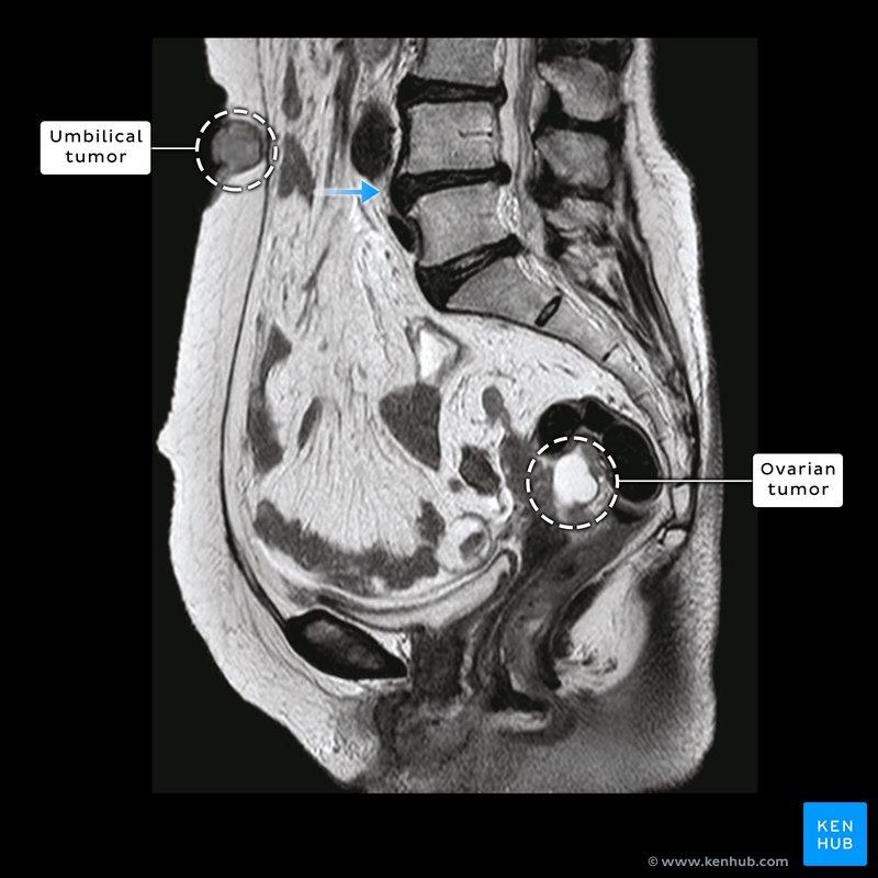 Ovarian and umbilical tumors - T1 MRI