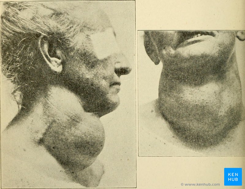 Goiter