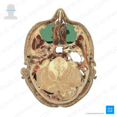 Maxillary sinus (Sinus maxillaris); Image: National Library of Medicine