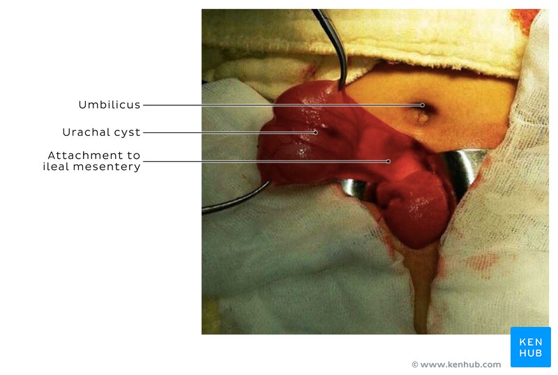 Cyst during the operation