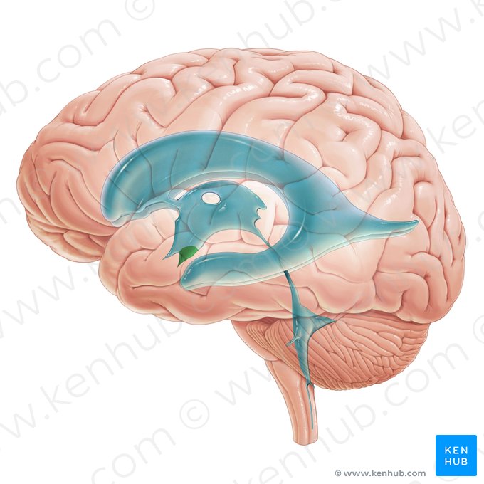 Recessus infundibuli ventriculi tertii (Recessus infundibuli des dritten Ventrikels); Bild: Paul Kim