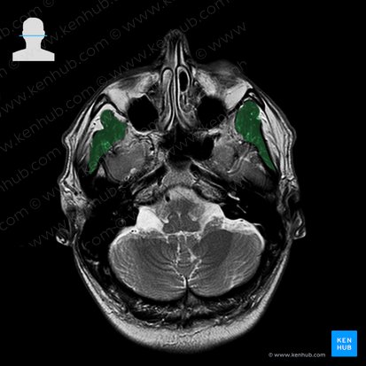 Musculus temporalis (Schläfenmuskel); Bild: 