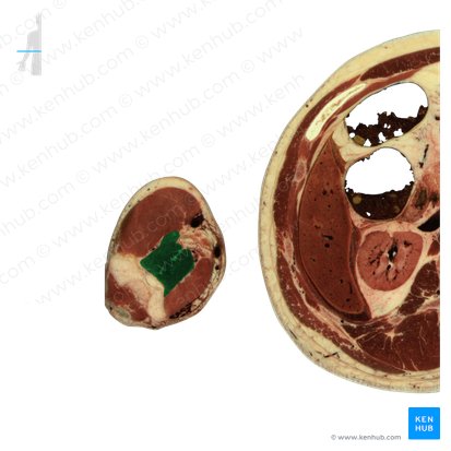 Músculo braquial (Musculus brachialis); Imagem: National Library of Medicine