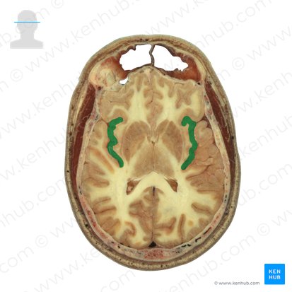 Insular lobe (Insula); Image: National Library of Medicine