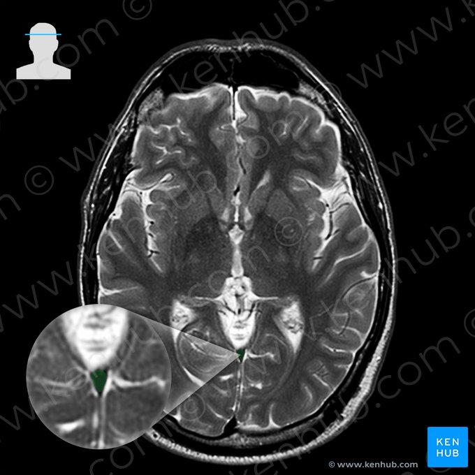 Sinus rectus (Gerader Blutleiter); Bild: 