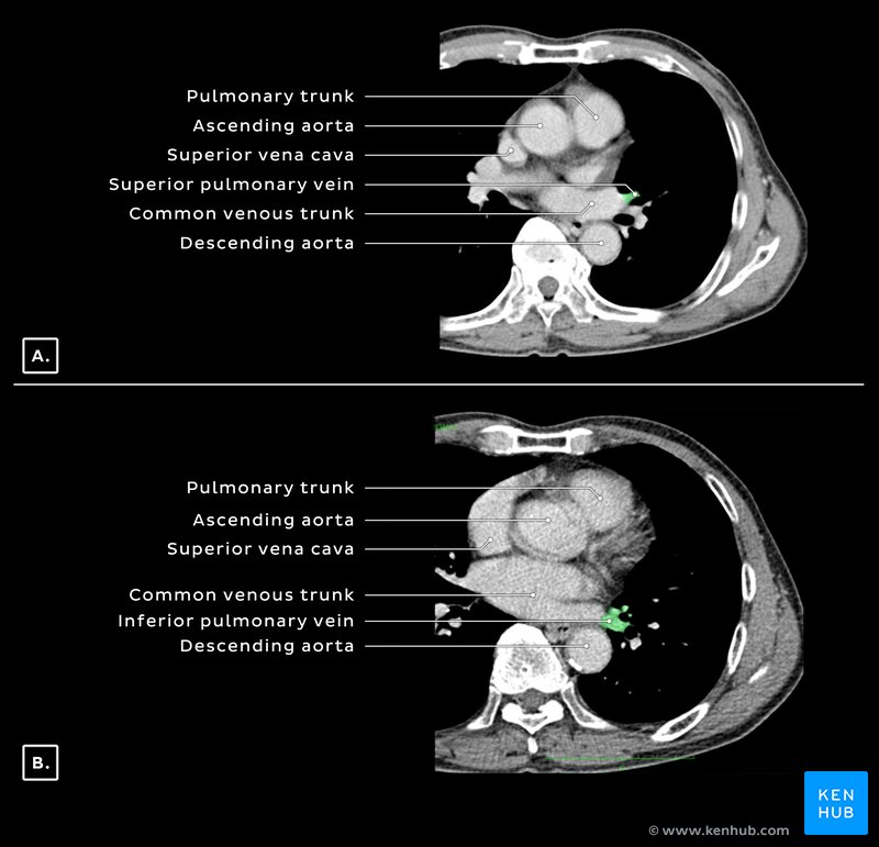 Pulmonary veins and common venous trunk