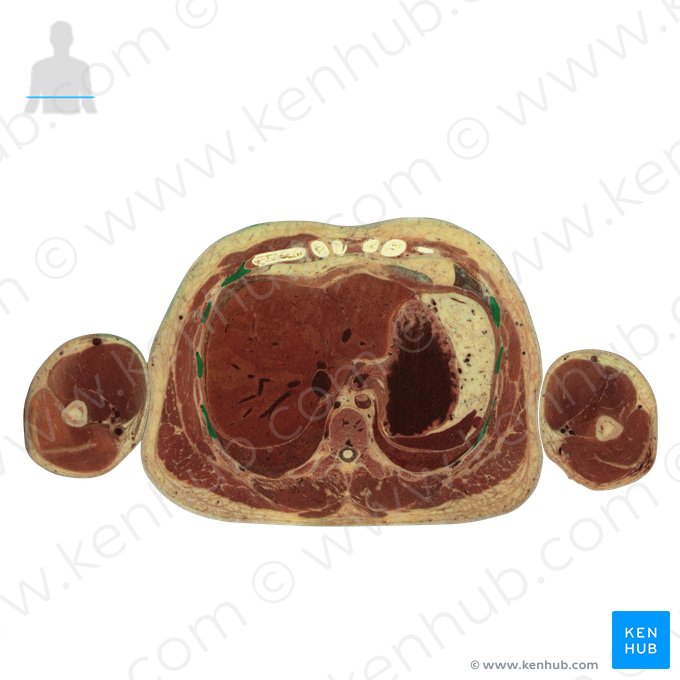 Internal intercostal muscles (Musculi intercostales interni); Image: National Library of Medicine