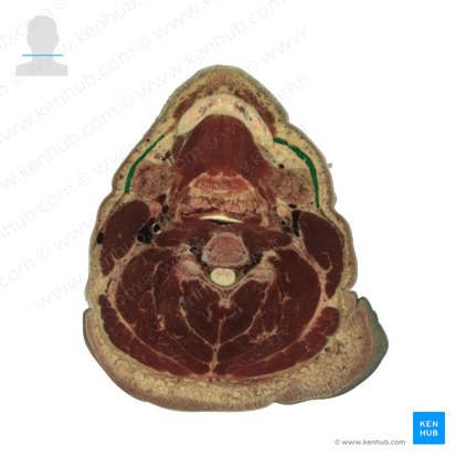 Platisma (Musculus platysma); Imagem: National Library of Medicine
