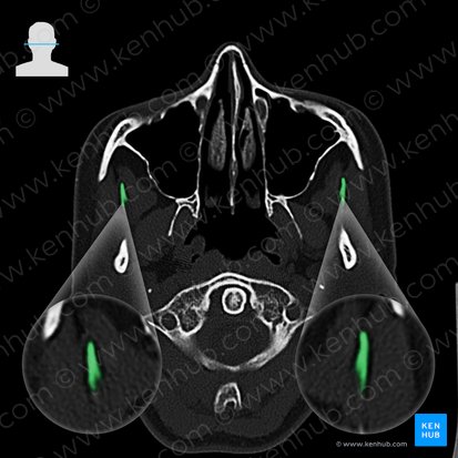 Coronoid process of mandible (Processus coronoideus mandibulae); Image: 
