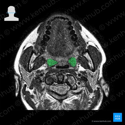 Palatine tonsil (Tonsilla palatina); Image: 