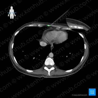 Processo xifoide do esterno (Processus xiphoideus sterni); Imagem: 