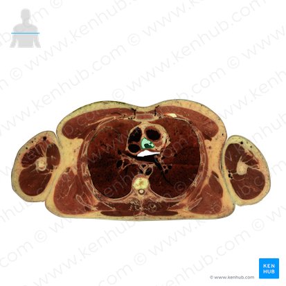Aorta ascendens (Aufsteigende Aorta); Bild: National Library of Medicine