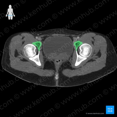 Púbis (Os pubis); Imagem: 