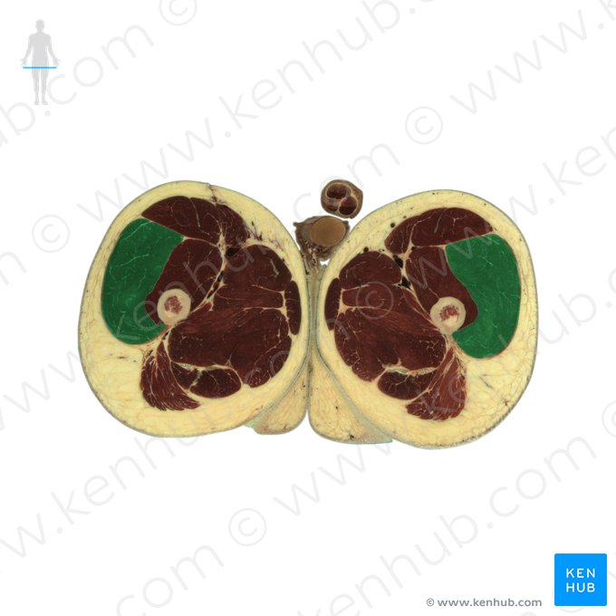 Músculo vasto lateral (Musculus vastus lateralis); Imagem: National Library of Medicine