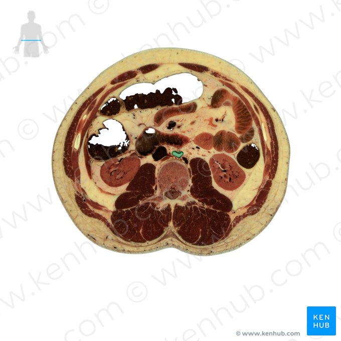 Aorta abdominalis (Bauchaorta); Bild: National Library of Medicine