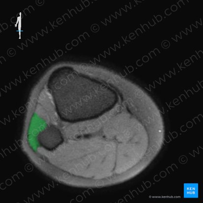 Musculus fibularis longus (Langer Wadenbeinmuskel); Bild: 