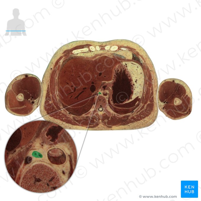 Ducto torácico (Ductus thoracicus); Imagem: National Library of Medicine