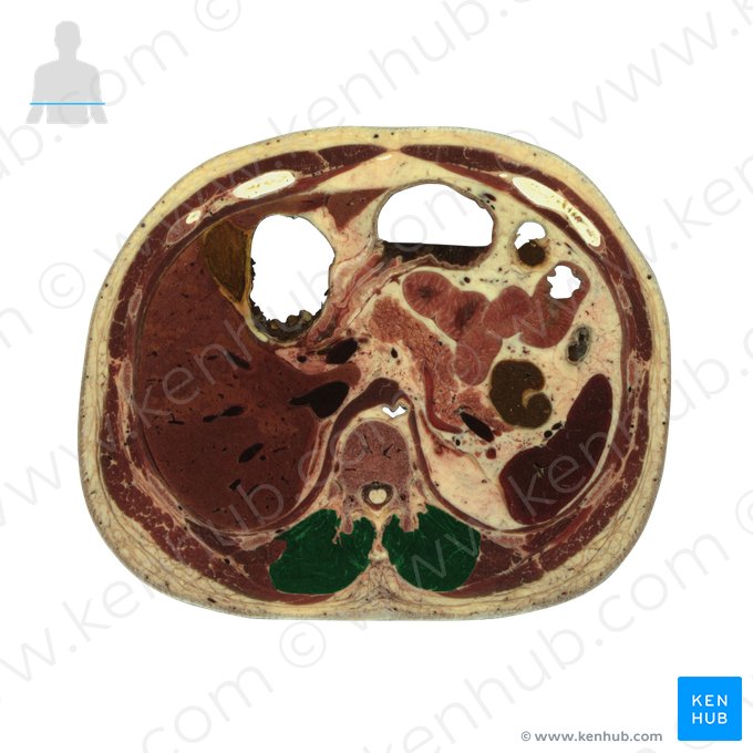 Multifidus muscle (Musculus multifidus); Image: National Library of Medicine