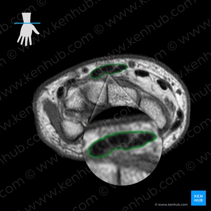 Bainha tendínea dos músculos extensor dos dedos e extensor do indicador (Vagina tendinum musculorum digitorum et extensoris indicis); Imagem: 