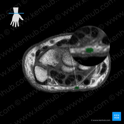 Tendão do músculo palmar longo (Tendo musculi palmaris longus); Imagem: 