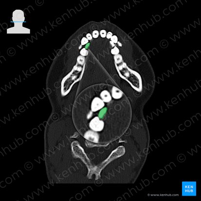 Mandibular right canine tooth (Dens caninus dexter mandibularis); Image: 