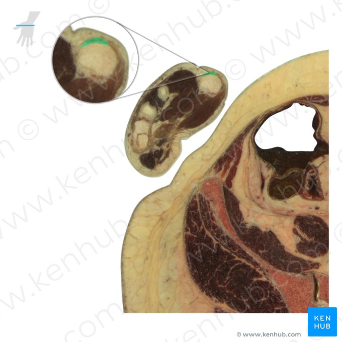 Tendão do músculo extensor longo do polegar (Tendo musculi extensoris pollicis longi); Imagem: National Library of Medicine