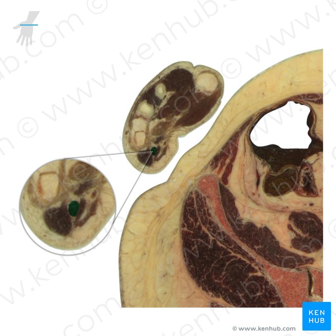 Músculo oponente do dedo mínimo (Musculus opponens digiti minimi manus); Imagem: National Library of Medicine