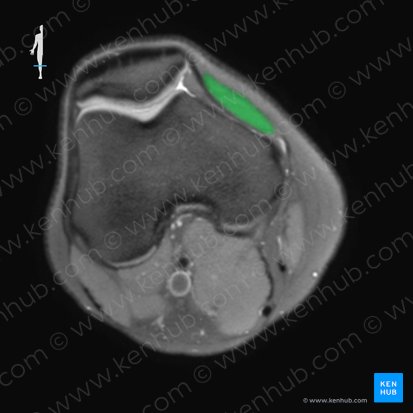 Músculo vasto medial (Musculus vastus medialis); Imagen: 