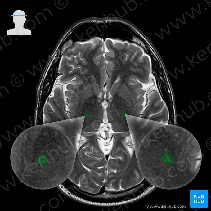 Trato piramidal (Tractus pyramidalis); Imagem: 