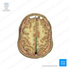 Hoz del cerebro (Falx cerebri); Imagen: National Library of Medicine