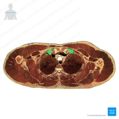 Costa & cartilago costalis 1 (1. Rippe und Rippenknorpel); Bild: National Library of Medicine