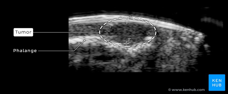 Glomus tumor of the finger - Ultrasound