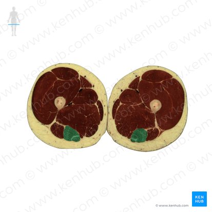 Músculo semitendinoso (Musculus semitendinosus); Imagen: National Library of Medicine