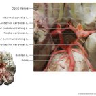 Clinical case: Optic neuropathy due to optic nerve compression