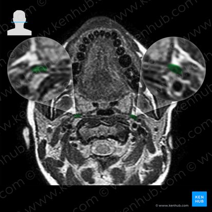 Músculo estilofaríngeo (Musculus stylopharyngeus); Imagem: 