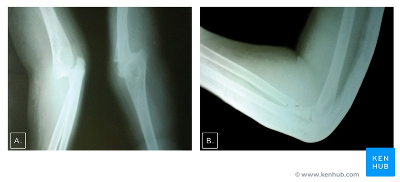 Posterior elbow dislocation