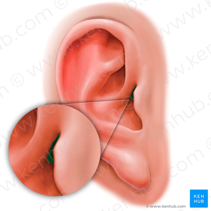 Incisura supratragica auriculae (Supratragische Kerbe); Bild: Paul Kim