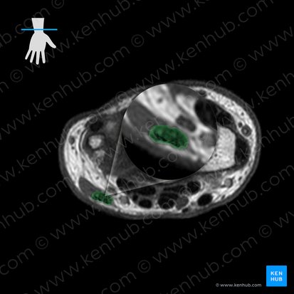 Tendon of flexor carpi ulnaris muscle (Tendo musculi flexoris carpi ulnaris); Image: 