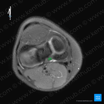 Ligamento cruzado posterior (Ligamentum cruciatum posterius); Imagen: 