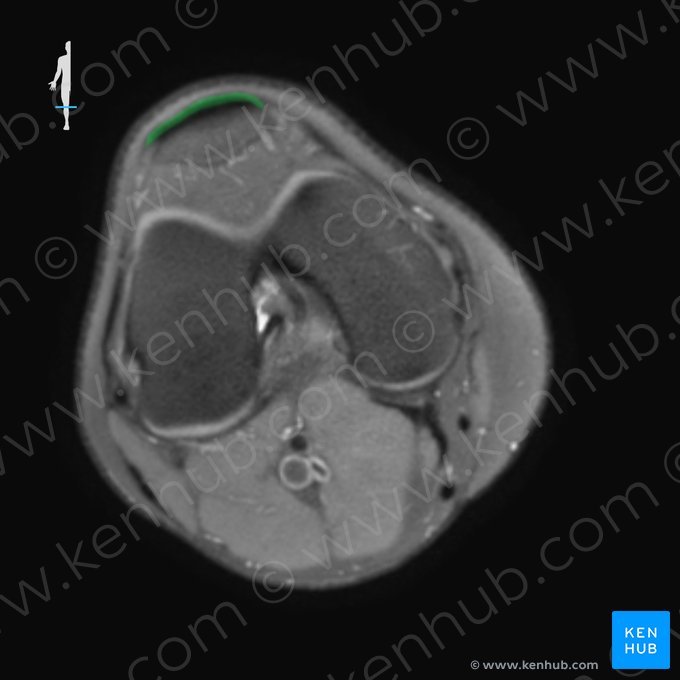 Ligamento patelar (Ligamentum patellae); Imagem: 