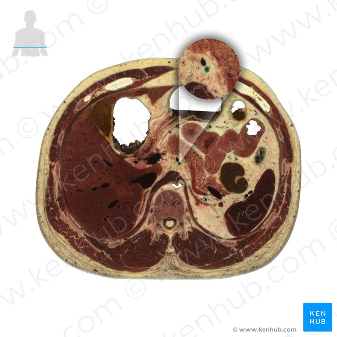 Artéria gástrica esquerda (Arteria gastrica sinistra); Imagem: National Library of Medicine