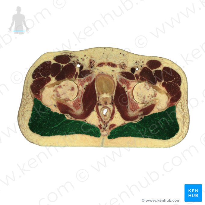 Gluteus maximus muscle (Musculus gluteus maximus); Image: National Library of Medicine