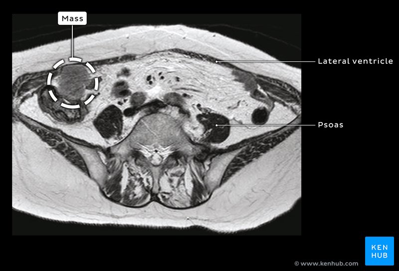 Intra-abdominal mass - axial MRI
