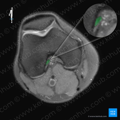 Ligamento cruzado anterior (Ligamentum cruciatum anterius); Imagen: 