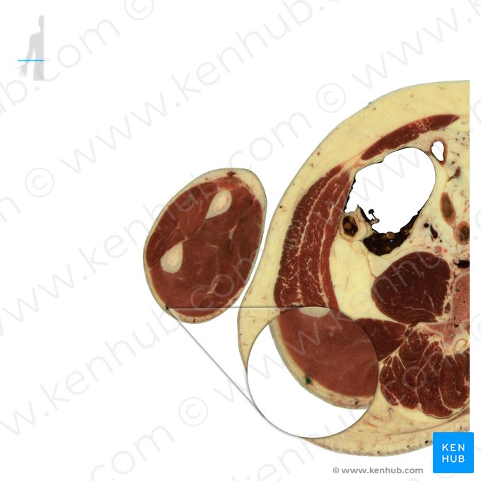 Basilic vein (Vena basilica); Image: National Library of Medicine