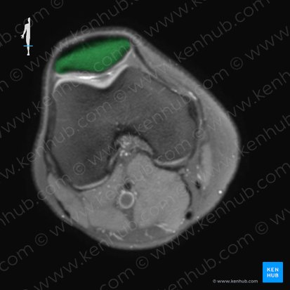 Patella; Image: 